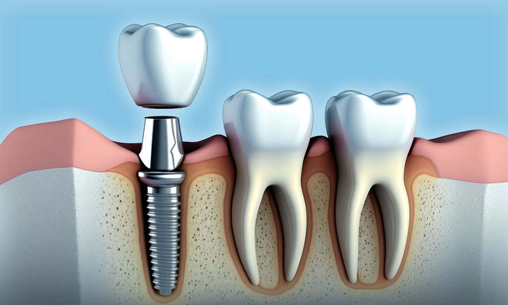 3D dental implant model showing artificial tooth root and crown beside natural teeth.
